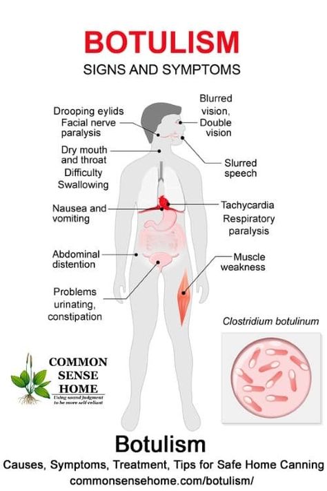 botulism causes - Google Search Lymphoma Symptoms Signs, Clostridium Botulinum, Foot Reflexology Massage, Botulinum Toxin, Canned Foods, Facial Nerve, Reflexology Massage, Botox Fillers, Foot Reflexology