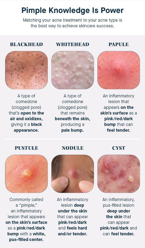 Types of Pimples Types Of Pimples, Different Types Of Acne, Blind Pimple, Pimples Under The Skin, Acne Overnight, Pimples On Face, Severe Acne, Types Of Acne, How To Get Rid Of Pimples