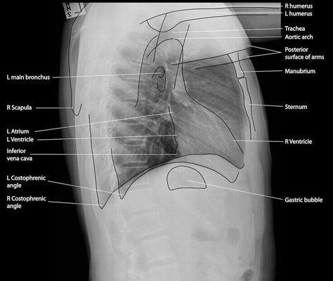 Lateral Chest Anatomy Chest X Ray, Radiology Schools, Medical Radiography, Radiologic Technology, Radiology Student, Radiology Imaging, Radiology Tech, Radiology Technologist, Family Nurse Practitioner