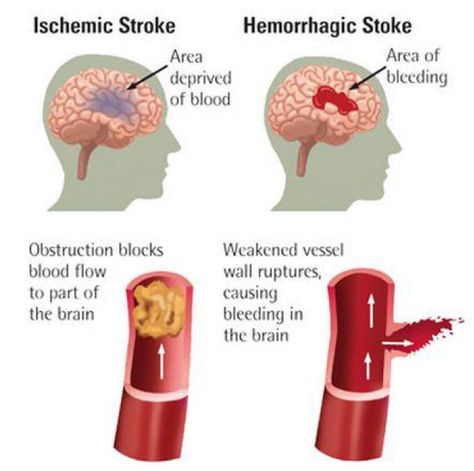 The types of stroke - ischaemic and haemorrhagic Emt Study, Nursing School Survival, Nurse Rock, Nursing School Tips, Nursing School Notes, Nursing Tips, Future Nurse, Nursing Study, Nursing Education