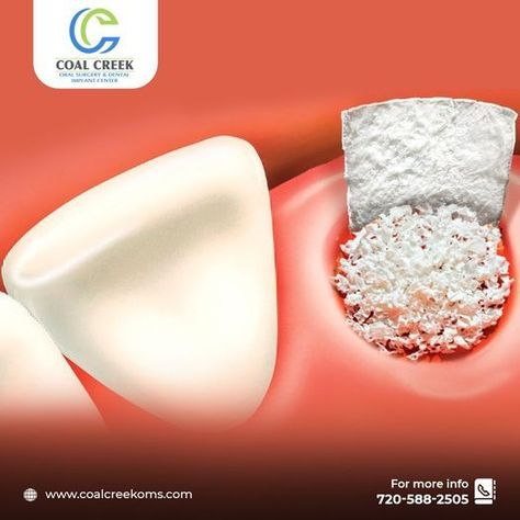 When getting an implant, there must be a sufficient amount of bones in the affected area. In such cases, bone grafting is done to help regrow any deteriorated bone. For more details contact us. 🌐 www.coalcreekoms.com ☎ +1720-588-2505 #CoalCreekOMS #OralSurgeon #OralSurgery #DentalImplant # Bone Grafting, Oral Surgeon, Dental Implants, Bones