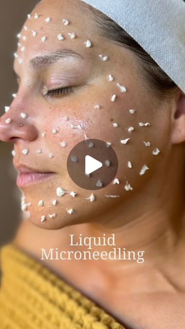 ᴅᴇᴛᴏx 𓄼 ᴍᴇᴅꜱᴘᴀ 𝒮𝒾𝓃𝒸𝑒 𝟤𝟢𝟢𝟣 on Instagram: "Liquid Microneedling 🪸  The newest form of mesotherapy without needles. The innovative ingredient “Micro-spear®” is based on micro simulation of your skins surface using 50,000 microscopic needles obtained from hydrolyzed marine sponge to stimulate collagen and cell turnover. —— No Needles, No Pain , Minimal to No Downtime! Can be done on all skin types!!!  —— CONTRAINDICATIONS • Currently pregnant or lactating • Current open wounds on the skin • Received Botox or fillers in the past 14 days • Received lasers, chemical peels, micro needling or mesotherapy in the past 7 days • Strong nut allergy (a small percentage of Macadamia Oil is present in the CELLSTORY PLUS Recovery Cream)  POST CARE EXPECTATIONS • Skin redness and dryness may occur Microdermabrasion Before And After, Micro Needling Before And After, Microneedling Before And After, Mesotherapy Face, Dermapen Microneedling, Skin Recipes, Nut Allergy, Skin Needling, Micro Needling