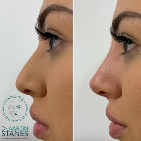 Nonsurgical Nose Job, Nose Surgery Rhinoplasty, Nose Fillers, Rhinoplasty Nose Jobs, Nose Reshaping, Pretty Nose, Beauty Procedures, Facial Fillers, Perfect Nose