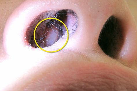 Why Do I Have Nasal Polyps? | WebMD Polyps In Nose, Sinus Polyps, Nose Problems, Nasal Polyps, Clear Your Sinuses, Parts Of The Nose, Chronic Sinusitis, Human Biology, Nose Picking