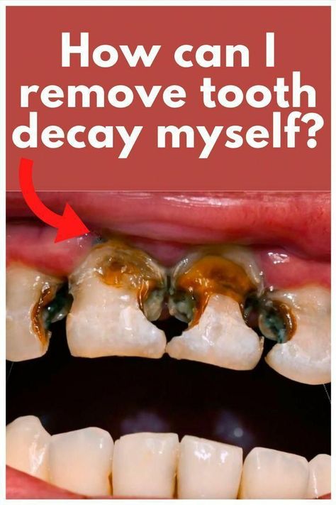 Cavity | teeth cavity | whitening | tooth problem |germs | teeth polish | teeth problem solution | decay | tooth decay | dental health | health teeth | dental | curiosity | dental problem | dentist | Fix Teeth, Tooth Cavity, Tooth Decay Remedies, Dental Cavities, The Teeth, Oral Care Routine, Gum Care, Receding Gums, Dental Problems