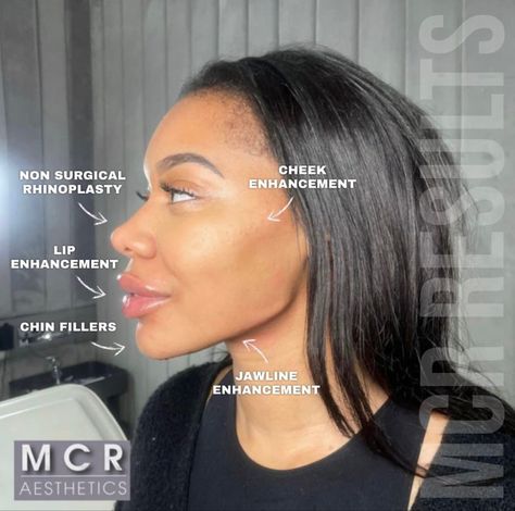 Nose Tip Filler, Facial Contouring Fillers, Nose Filler Before After, Lip Filler Black Women, Face Balancing Fillers, Face Contouring Fillers, Jawline Fillers Before And After, Cheek Fillers Before And After Face, Facial Balancing Filler