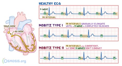 Mobitz type I is a type of 2nd degree AV block, which refers to an irregular cardiac rhythm (arrhythmia), that reflects a conduction block in the electrical conduction system of the heart Pr Interval, Cardiac Rhythms, P Wave, Nursing School Essential, Nurse Study Notes, Cardiac Nursing, Heart Blocks, Medicine Student, Nursing School Notes