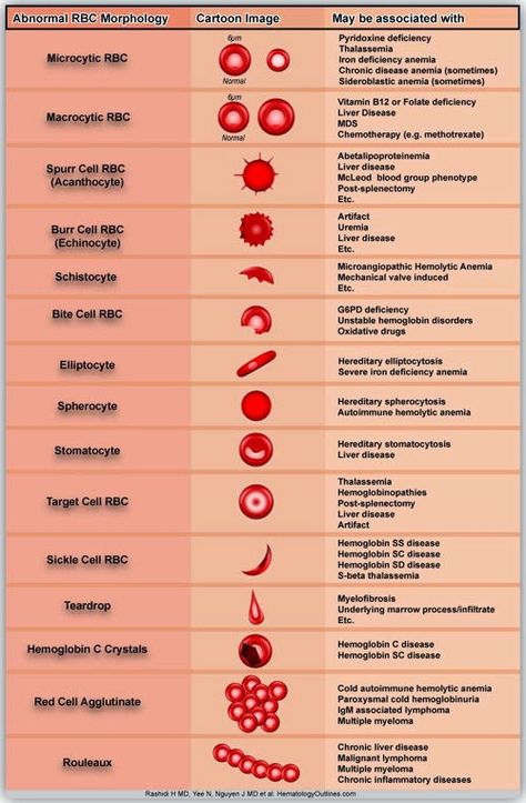 Medical Laboratory and Biomedical Science: Reporting and grading of abnormal red blood cell m... Rbc Morphology, Medical Lab Technician, Vet Tech School, Medical Laboratory Technician, Med Lab, Medical Laboratory Scientist, Laboratory Technician, Medical Lab, Vet Medicine