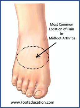 Midfoot arthritis is characterized by pain and swelling in the midfoot, aggravated by standing and walking. There is often an associated bony prominence on the top of the foot. Usually the symptoms develop gradually over time, although it can occur following a major midfoot injury, such as a Lisfranc injury. Non-operative treatme Thumb Pain Relief, Foot Pain Relief Remedies, Lisfranc Injury, Bag Of Ice, Arthritic Pain, Pain Relief Remedies, Foot Exercises, Foot Pain Relief, Knee Exercises