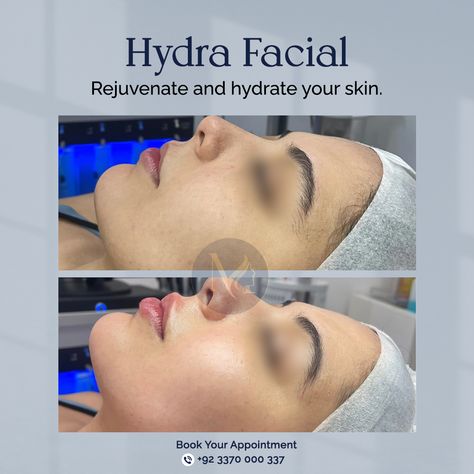 Check out these stunning before and after results from one of our happy clients who experienced the HydraFacial difference. Hydrafacial Benefits, Hydrodermabrasion Facial, Dermaplane Facial Benefits, Benefits Of Dermaplaning Facial, Botox Fillers, Aesthetic Clinic, Hair Transplant, Facial, Photo And Video