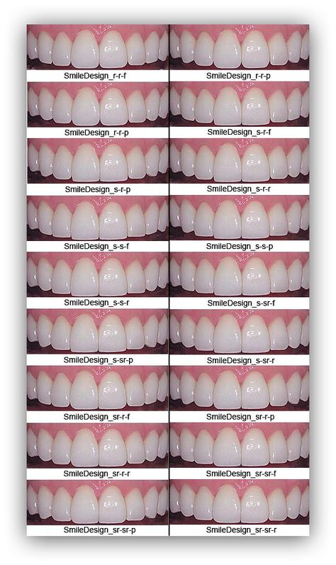 All On Four Dental Implants, Teeth Makeover, Perfect Smile Teeth, Cosmetic Dentistry Procedures, New Teeth, Dental Aesthetics, Veneers Teeth, Dental Work, Dental Anatomy