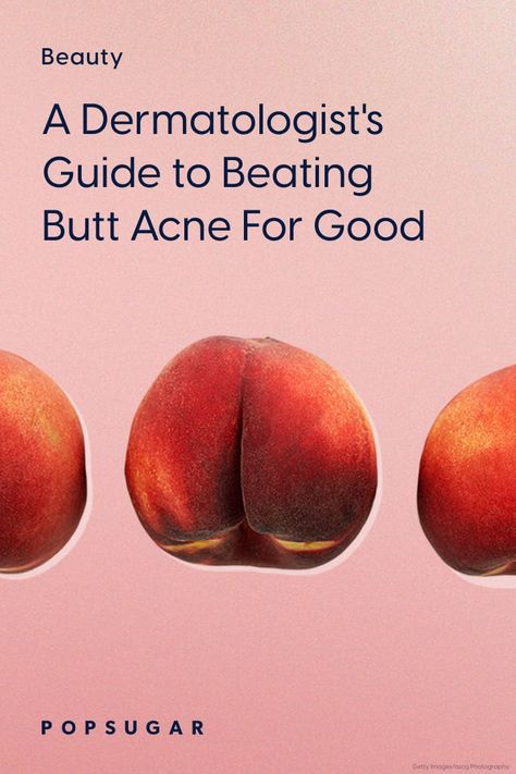 Best Butt-Acne Treatments, According to Dermatologists How To Get Rid Of Thigh Acne, How To Get Rid Of Buttocks Acne Quick, Smooth Buttocks Skin, How To Get Rid Of Buttocks Acne At Home, How To Get Rid Of Buttocks Acne, But Acne, Body Acne Products, Buttocks Acne, Blind Pimple