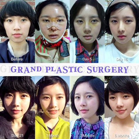 Grand’s Makeover! 1) Eyes : Double eyelid surgery, Ptosis Correction, Medial Epicanthoplasty 2) Nose: Augmentation Rhinoplasty, Tip-plasty 3) Face contouring : Zygoma Implant and Chin augmentation implant Free consultation: Grand Plastic Surgery Tel: (+82) 70-7119-1580 Email: grandps.en@gmail.com Facebook: http://facebook.com/grandplasticsurgery Webstie: http://eng.grandsurgery.com/ Tumblr: http://grandsurgery.tumblr.com/ Zygoma Reduction, Plastic Surgery Korea, Chin Augmentation, Facial Contouring, Nose Surgery, 3 Face, Double Eyelid, Reconstructive Surgery, Cosmetic Procedures