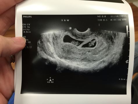 8 weeks twins 3 Weeks Pregnant Ultrasound Twins, Ultrasound Pictures Twins, Fake Ultrasound Pictures 4 Weeks, 8weeks Pregnant Ultrasound, Twin Ultrasound Pictures 8 Weeks, Twin Ultrasound 6 Weeks, Twins Sonogram, Twins Manifestation, Identical Twins Ultrasound