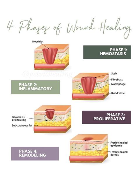 4 Stages of Wound Healing | physical therapy Stages Of Wound Healing, Wound Healing Stages, Wound Healing Nursing, Ostomy Nursing, Wound Nurse, Peds Nursing, Nbcot Exam, Wound Care Nursing, Rectus Abdominis Muscle