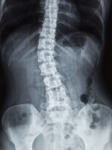 The Spiritual Cause of Scoliosis • Energetic Wisdom Spinal Injury, Southern Maine, Sciatic Nerve Pain, Rules And Regulations, Nerve Damage, Insurance Car, Sciatic Nerve, Body Balance, Car Dealers