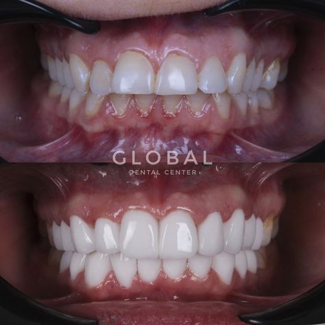 laminate veneer Composite Veneers, Hollywood Smile, Porcelain Veneers, Front Teeth, Dental Center, Tooth Sensitivity, Dental Crowns, Antalya Turkey, Grinding Teeth