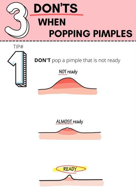 What pimples should you not pop? When to leave a pimple alone. Although people can pop some noninflamed whiteheads and blackheads if they take the necessary precautions, they should never try to pop or extract inflamed acne. This type of acne is deeper in the skin and may be more likely to cause scarring and infection if a person tries to squeeze it Skin Notes, Inflamed Pimple, Popping Pimples, Blind Pimple, Pimples Under The Skin, Pimples Remedies, How To Get Rid Of Pimples, Basic Skin Care Routine, Perfect Skin Care Routine