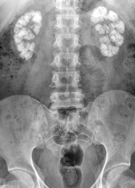 Medullary Nephrocalcinosis-Plain Film - Sumer's Radiology Blog Urinary Catheterization, Renal Calculi, Xray Technician, Vascular Surgery, Medicine Notes, Medical Knowledge, Radiology, Calculus, Frames For Canvas Paintings