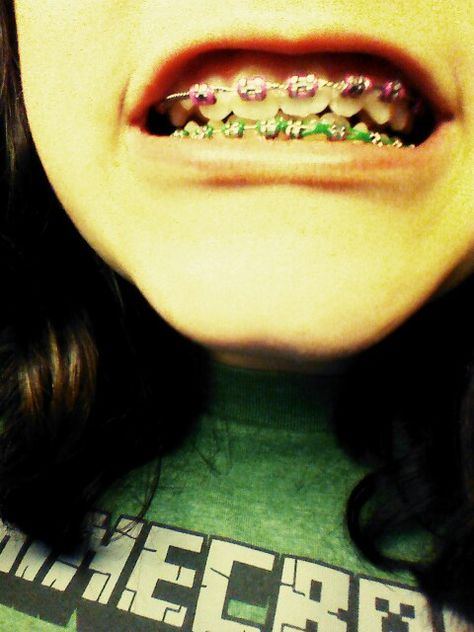 Kelly green and neon pink for braces it makes you look like you have tulips in your mouth Braces Hot Pink, Pink And Green Braces, Lime Green Braces, Lime Green Power Chain Braces, Neon Green Braces, Pink And Purple Braces Teeth, Pink Braces, Green Braces, Braces Cost