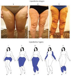 Lipedema Legs, Dercums Disease, Body Inflammation, Lymph System, Ehlers Danlos Syndrome, Adipose Tissue, Hormonal Changes, Trunk, Massage