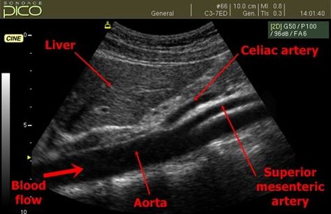 Sonography Notes, Ultrasound Anatomy, Iliac Artery, Radiography Student, Abdominal Ultrasound, Diagnostic Medical Sonography Student, Ultrasound School, Cardiac Sonography, Vascular Ultrasound