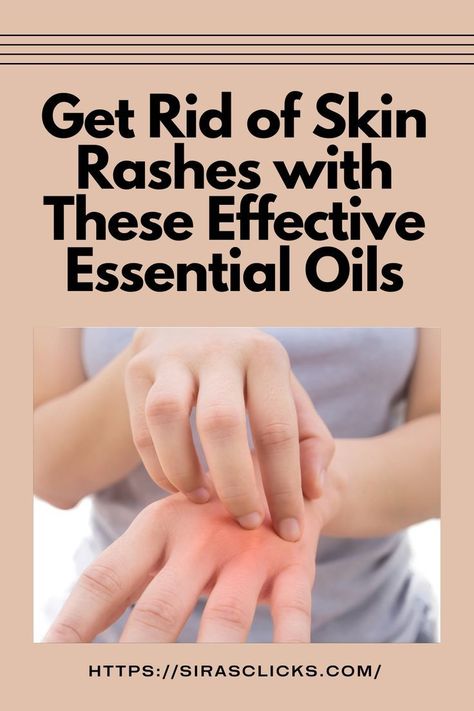 Get Rid of Rashes with these Effective Essential Oils Essential Oil Recipes For Skin Rashes, Essential Oils For Staff Infection, Essential Oils For Rashes Skin, Essential Oils For Itchy Rash, Essential Oils For Rash And Itching, Essential Oils For Rash, Skin Rash Remedies, Heat Rash Remedy, Home Remedies For Rashes