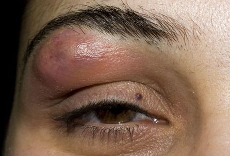 Boil on eyebrow Ingrown Eyebrow Hair, Pimple On Eyelid, Swollen Eye, Swollen Eyelid, Painful Pimple, Swollen Eyes, Eyebrow Piercing, Skin Disorders, Roots Hair