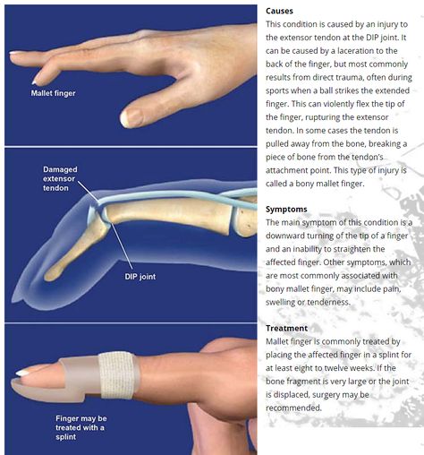 Mallet Finger - They may represent an isolated tendinous injury or occur in combination with an avulsion fracture of the dorsal base of the distal phalanx - untreated mallet finger or incomplete healing may progress to a swan neck deformity Swan Neck Deformity, Avulsion Fracture, Nbcot Exam, Mallet Finger, Finger Injury, Hand References, Pa School, Swan Neck, Hand Therapy