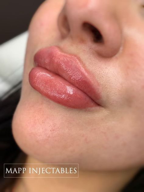 Plump lip filler Types Of Lip Filler Shapes, Lip Fillers Before And After 1ml Russian, Russian Lips Filler 1ml, 1 Ml Lip Filler, 1ml Lip Filler, Lip Goals, Russian Lips, Filler Lip, Lips Shape