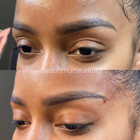 Ellory Lien, RN, BSN on Instagram: “Feeling so foxy 😍 Pdo Fox eye thread on this beauty to give the pulled back snatched look! * * * * 👩🏼‍⚕️ To see me as a patient for a…” Foxy Elongated Eyebrows, Fox Eye Surgery, Fox Eye Thread Lift, Fox Eye Lift, Fox Eyebrows, Eyebrow Shaping Threading, Kpop Plastic Surgery, Jaw Reduction Surgery, V Line Surgery