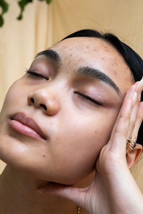 The “Skin Neutrality” Movement Is Growing — But I Can’t Get On Board #refinery29 https://www.refinery29.com/en-us/2019/12/8992367/skin-neutrality-positivity-acne Imperfect Skin Aesthetic, Real Skin Aesthetic, Acne Positivity Art, Acne Photoshoot, Strawberry Freckles, Real Skin Texture, Acne Aesthetic, Imperfect Skin, Beautiful Acne