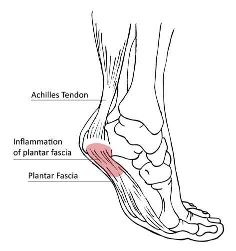 Plantar Fasciitis FAQ's Friendship Photography, Pinched Nerve, Patient Education, Shock Wave, Calf Muscles, Medical Help, Medical Conditions, Educational Materials, Health