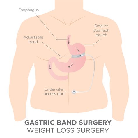 The prevalence of obesity in the United States is rising due to several factors that promote weight gain. Weight loss methods work for some and not others. When all else has failed, you may qualify for bariatric surgery, including gastric band surgery. Gastric banding, often known as lap-band surgery, is one of the surgical therapies for obesity. In this article, we will be looking at the basics of gastric banding and gastric band side effects. #GastricBand #BariatricSurgerySideEffects Lap Band, Gastric Band, Bariatric Surgeon, Neck Exercises, After Surgery, Patient Experience, Abdominal Pain, Gain Weight, Side Effects