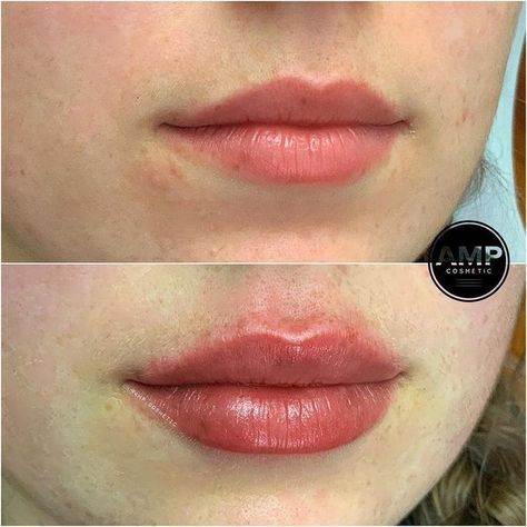 Face Atonomy, Lips Injection, Lip Fillers Juvederm, 1ml Lip Filler, Full Lips Makeup, Cosmetic Nurse, Lip Surgery, Heart Shaped Lips, Lips Inspiration