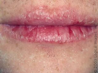 chapped lips Remedies For Dry Lips, Remedies For Chapped Lips, Dry Lips Remedy, Chapped Lips Remedy, Sore Lips, Dehydrated Lips, Cracked Lips, Peeling Skin, Chapped Lips