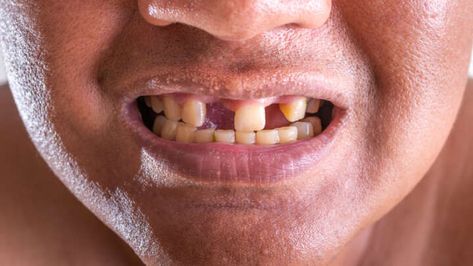 False teeth could one day be a thing of the past, thanks to the discovery of an antibody that sparks the regeneration of lost teeth. By inhibiting the acti Cavity Filling, Dental Bonding, Tooth Cavity, False Teeth, Human Teeth, Emergency Dentist, Missing Teeth, Dental Bridge, Dental Problems