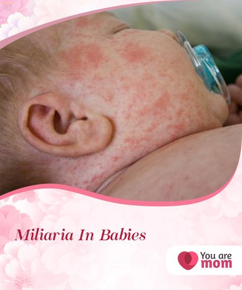 Miliaria In Babies   Miliaria in babies, also known as sudamina, is more common than you can #imagine. It is a skin rash that occurs in babies due to their #delicate #skin.  #Health Newborn Rash On Face, Heat Rash Remedy For Babies, Heat Rash On Face, Face Rash Remedies, Newborn Rash, Skin Rash On Face, Baby Rash On Face, Baby Heat Rash, Heat Rash Remedy