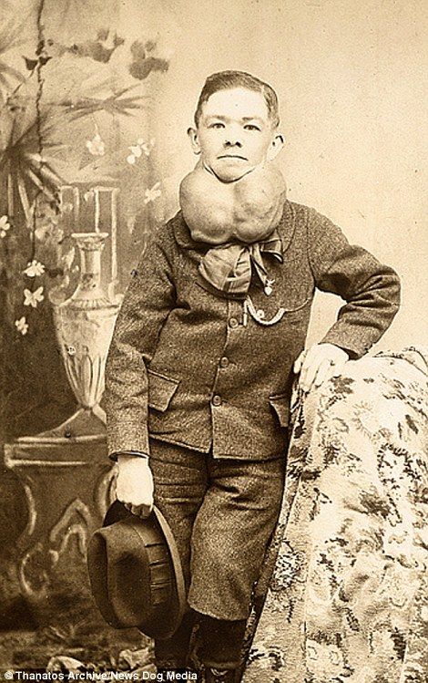 Weird Old Photos, Vintage Oddities, Sideshow Freaks, Post Mortem Pictures, Human Oddities, Conjoined Twins, Creepy Photos, Old Portraits, Strange Photos