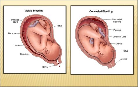 Where Is The Appendix Located, Placental Abruption Nursing, Benefits Of Placenta Encapsulation, Abruptio Placenta Nursing, Tetralogy Of Fallot Nursing, Anterior Placenta, Medical Diagnosis, Ob Nurse, Ob Nursing