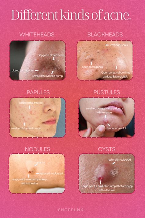 Unlock the secrets of your skin with "Understanding Acne Types: What Your Pimples Reveal About Your Skin and Style." Discover the meanings behind where pimples are located, from papules to nodular acne. Explore essential skincare facts and high school outfit tips for oily skin. Visit our skincare shop for expert advice and products tailored for you. 

#Skincare #AcneTypes #BeautyTips #OilySkin #Fashion Where Pimples Are And What They Mean, Papules Acne, Nodule Acne, What Causes Pimples, Nodular Acne, Highschool Outfits, How To Reduce Pimples, Skin Facts, Tips For Oily Skin