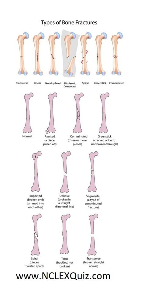 Future Surgeon, Surgical Technologist Student, Types Of Fractures, Nursing School Inspiration, Types Of Bones, Radiology Student, Nurse Study, Radiology Technician, Bells Palsy