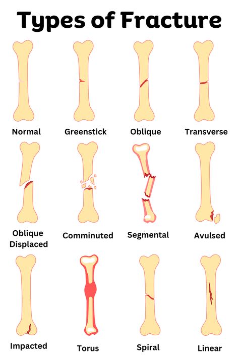 Types of Bone Fractures Names Types Of Fractures, Types Of Bones, Bones Series, Human Skeleton Anatomy, Bone Fracture, Skeleton Anatomy, Studying Law, Body Systems, Human Condition