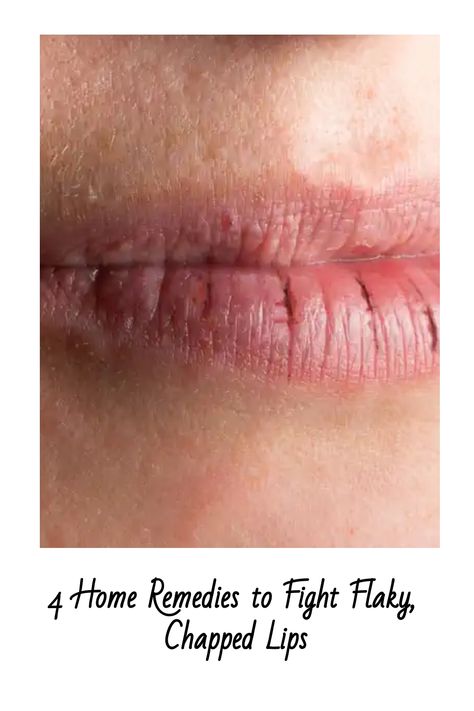 Chapped Lips How To Get Rid Of Chapped Lips, Blister On Lip, Chapped Lips Remedy, Pure Aloe Vera, Cracked Lips, Bottom Lip, Exfoliating Scrub, Flaky Skin, Chapped Lips