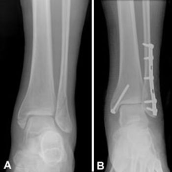 Broken Ankle Cast, Ankle Fracture Recovery, Fractured Ankle, Ankle Cast, Ankle Surgery Recovery, Broken Ankle Recovery, Ankle Ligaments, Ankle Fracture, Ankle Exercises