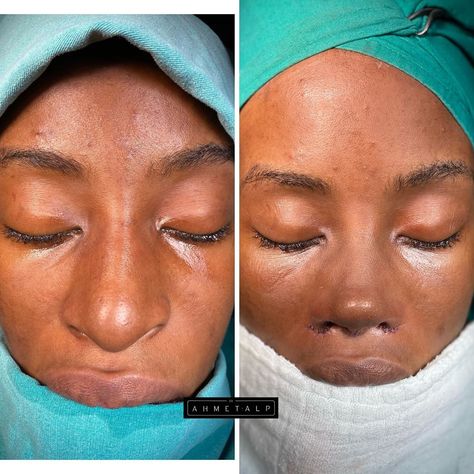 Nose Job Black Women, Bulbous Nose Rhinoplasty Before After, Ethnic Nose Job, Nose Goals, Ethnic Nose, Books Summary, Facial Balancing, Nose Plastic Surgery, Nose Surgery Rhinoplasty