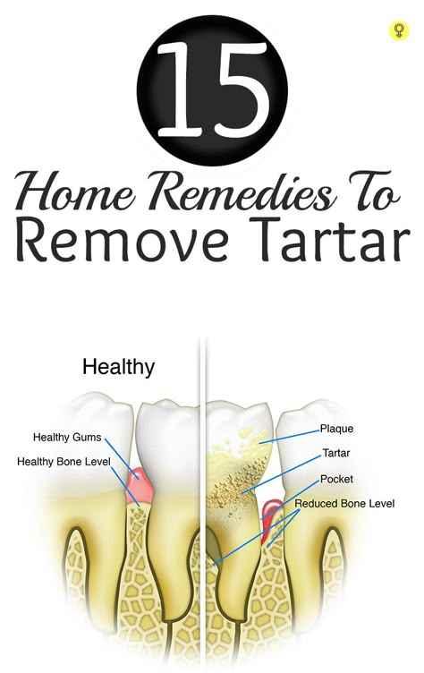 Tartar is a yellowish brown calcified material formed on the surface of teeth. Check out these effective home remedies for removing tartar and preventing it from growing further Dental Health Care, Nice Teeth, Teeth Health, Oral Care Routine, Receding Gums, Oral Health Care, Sensitive Teeth, Amazing Home, Tooth Decay