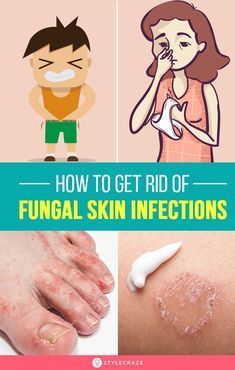 Fungal Infection Remedies, Fungal Infection Skin, Home Remedies For Skin, Skin Care Routine For 20s, Infection Prevention, Fungal Nail, Bacterial Infection, Fungal Infection, Natural Treatments