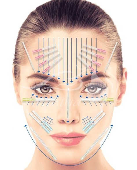 A Comprehensive Guide to PDO Thread Lift - Yastrid Medical Aesthetic Supplier Pdo Threading, Thread Lift Face, Pdo Thread Lift, Face Plastic Surgery, Facial Injections, Pdo Threads, Skin Anatomy, Face Lift Surgery, Botox Alternative