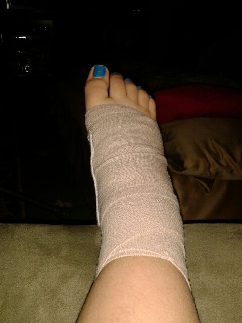 Yay sprained ankle Leg Plaster Snapchat, Leg Fracture Snap, Leg Injury Snapchat Streaks, Sprained Ankle Snapchat, Injured Leg Snapchat, Leg Bandage Snapchat, Sprained Ankle Remedies, Broke Leg Snapchat, Sprained Leg